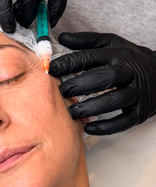 Clínica Dermoestética en Alicante | Bioestimulación