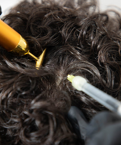 Clínica Dermoestética en Alicante | Mesoterapia capilar