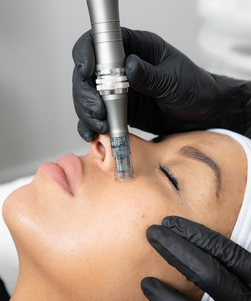 Clínica Dermoestética en Alicante | Microneedling (dermapen)