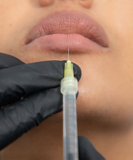 Clínica Dermoestética en Alicante | Relleno de labios