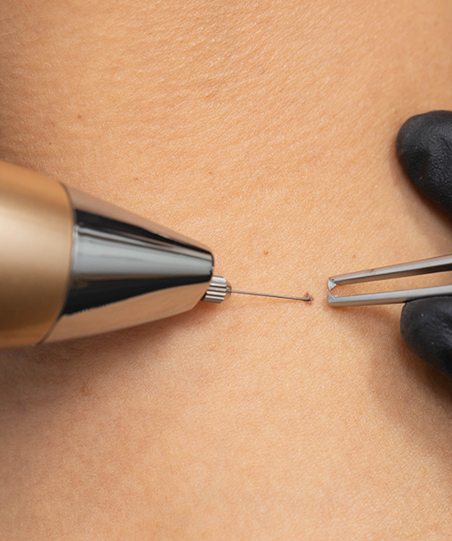 Clínica Dermoestética en Alicante | Eliminación verrugas