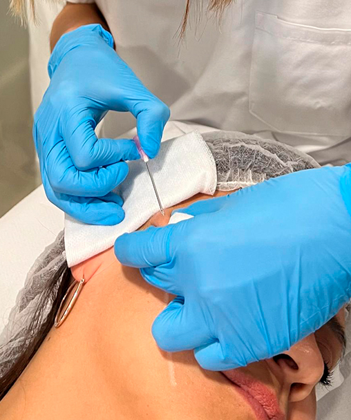 Clínica Dermoestética en Alicante | Hilos tensores